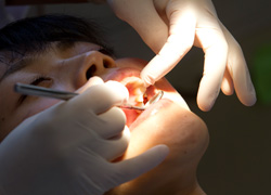 一般歯科(虫歯治療)